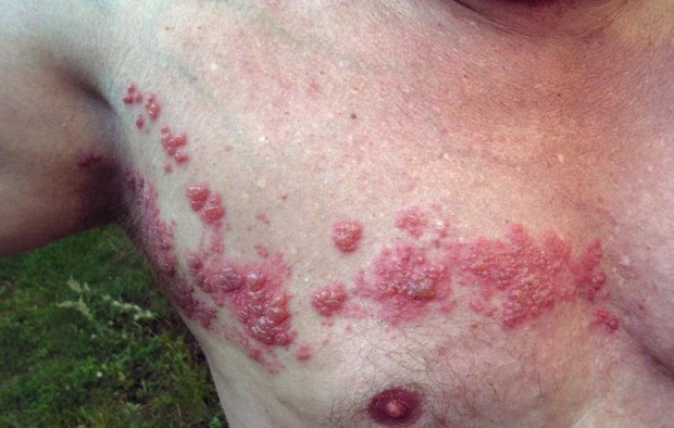 Herpes zoster: opgelet voor CVA